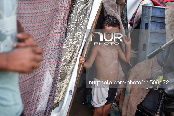 A Palestinian boy suffers from a skin rash at a makeshift camp for displaced Palestinians in Deir al-Balah, Gaza Strip, on August 24, 2024,...