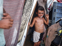 A Palestinian boy suffers from a skin rash at a makeshift camp for displaced Palestinians in Deir al-Balah, Gaza Strip, on August 24, 2024,...