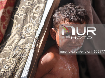 A Palestinian boy suffers from a skin rash at a makeshift camp for displaced Palestinians in Deir al-Balah, Gaza Strip, on August 24, 2024,...