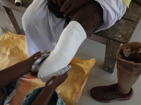 A worker covers a structure with plaster of Paris before manufacturing a prosthetic limb for Pappu Sarnakar, a forty-two-year-old three-whee...