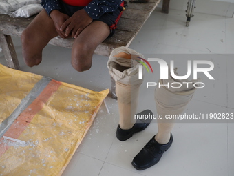 Pappu Sarnakar, a forty-two-year-old amputee and three-wheeler driver, waits for new prosthetic limbs inside the Rehabilitation & Research C...