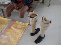 Pappu Sarnakar, a forty-two-year-old amputee and three-wheeler driver, waits for new prosthetic limbs inside the Rehabilitation & Research C...