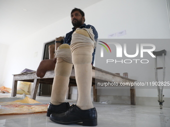 Pappu Sarnakar, a forty-two-year-old amputee and three-wheeler driver, waits for new prosthetic limbs inside the Rehabilitation & Research C...