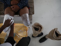 A worker covers a structure with plaster of Paris before manufacturing a prosthetic limb inside the Rehabilitation & Research Centre, a unit...