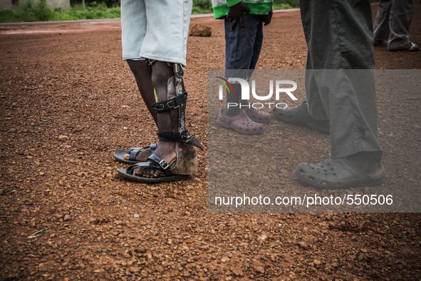 Prosthetic adaption in the leg of a boy made long time ago in the Bombuaka workshop of prostheses, Togo 