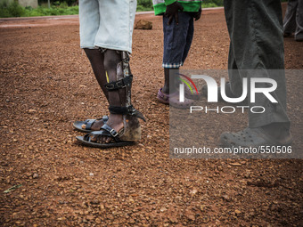 Prosthetic adaption in the leg of a boy made long time ago in the Bombuaka workshop of prostheses, Togo (