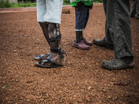 Prosthetic adaption in the leg of a boy made long time ago in the Bombuaka workshop of prostheses, Togo (