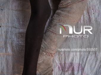 Legs of a boy after surgery in the hospital of Don Orione center in  Bombuaka, Togo (