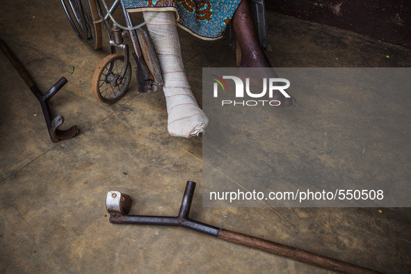 Legs of a man in a wheelchair after surgery in the hospital of Don Orione center in  Bombuaka, Togo 