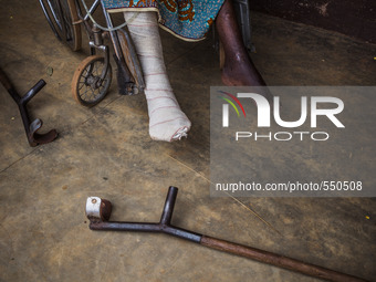 Legs of a man in a wheelchair after surgery in the hospital of Don Orione center in  Bombuaka, Togo (