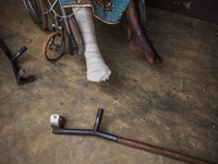 Legs of a man in a wheelchair after surgery in the hospital of Don Orione center in  Bombuaka, Togo (