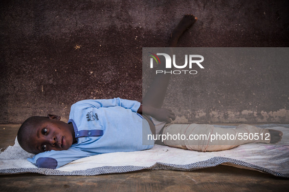 Legs of a child after surgery in the hospital of Don Orione center in  Bombuaka, Togo 