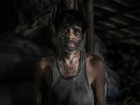 A worker who has been working at Dhapa west dumping ground for 13 years and got skin disease, Kolkata, India. January 17, 2015.  *** Go to h...